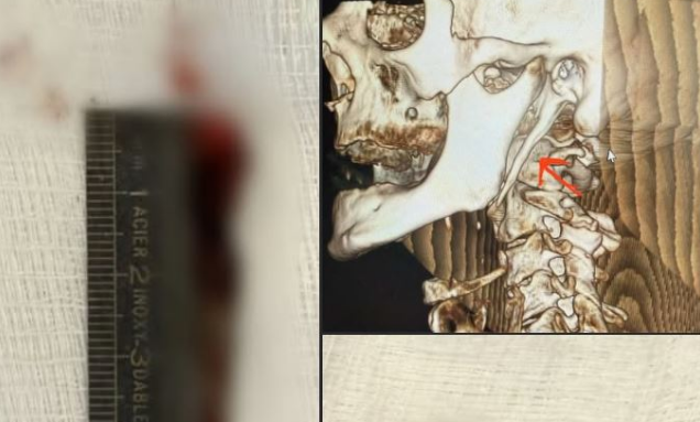 Për herë të parë në Kosovë kryhet me sukses operacioni për Sindromën Eagle